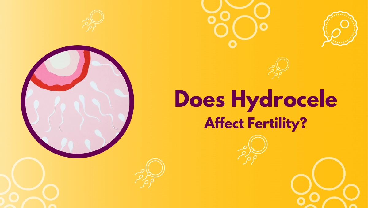 Can a Hydrocele Affect Fertility or Sperm? Find Out About Hydrocele Effects