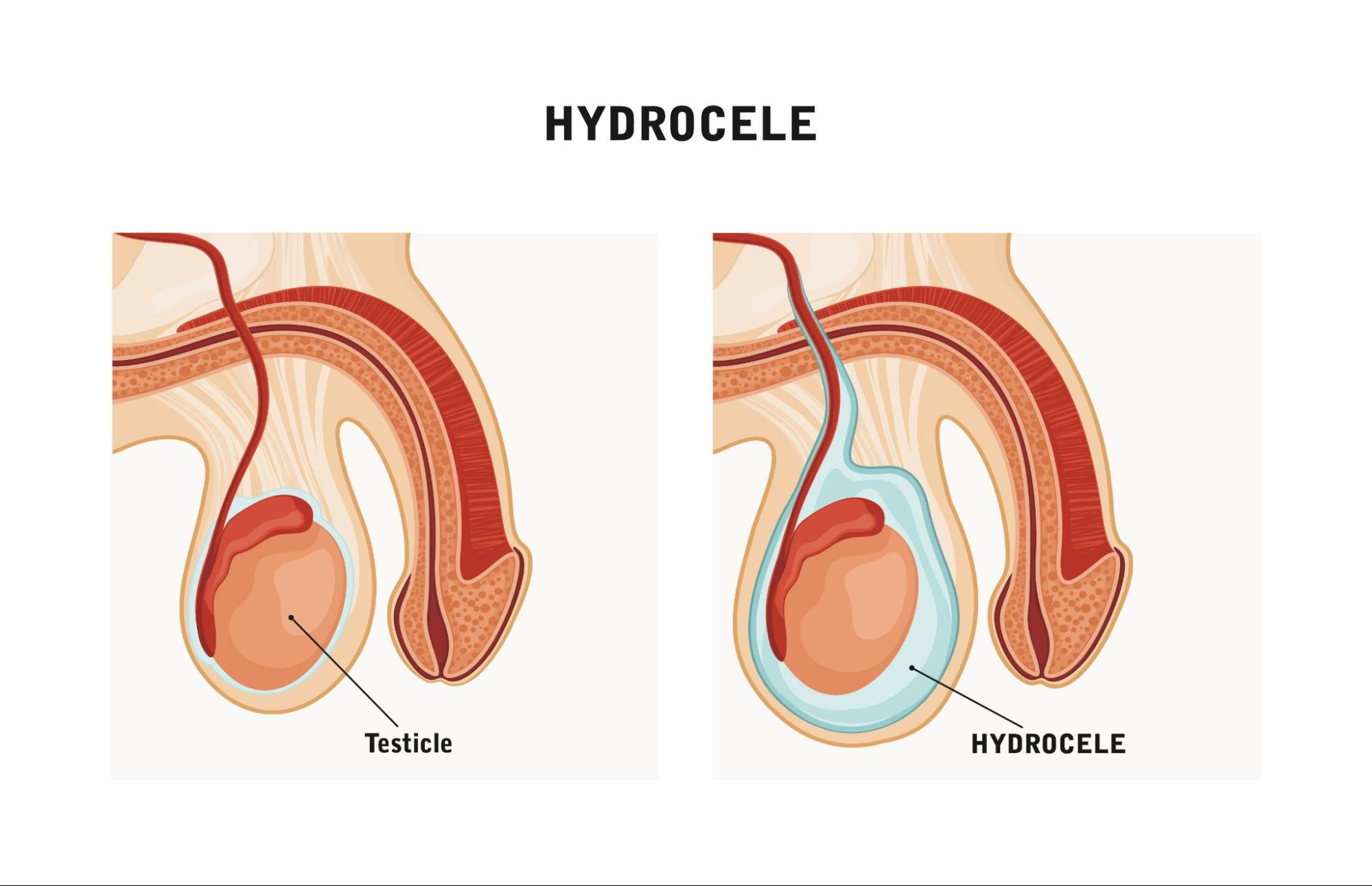 Can a Hydrocele Affect Fertility or Sperm? Find Out About Hydrocele Effects