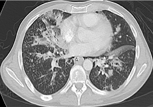 How Excipient Lung Disease is Diagnosed A Practical Guide