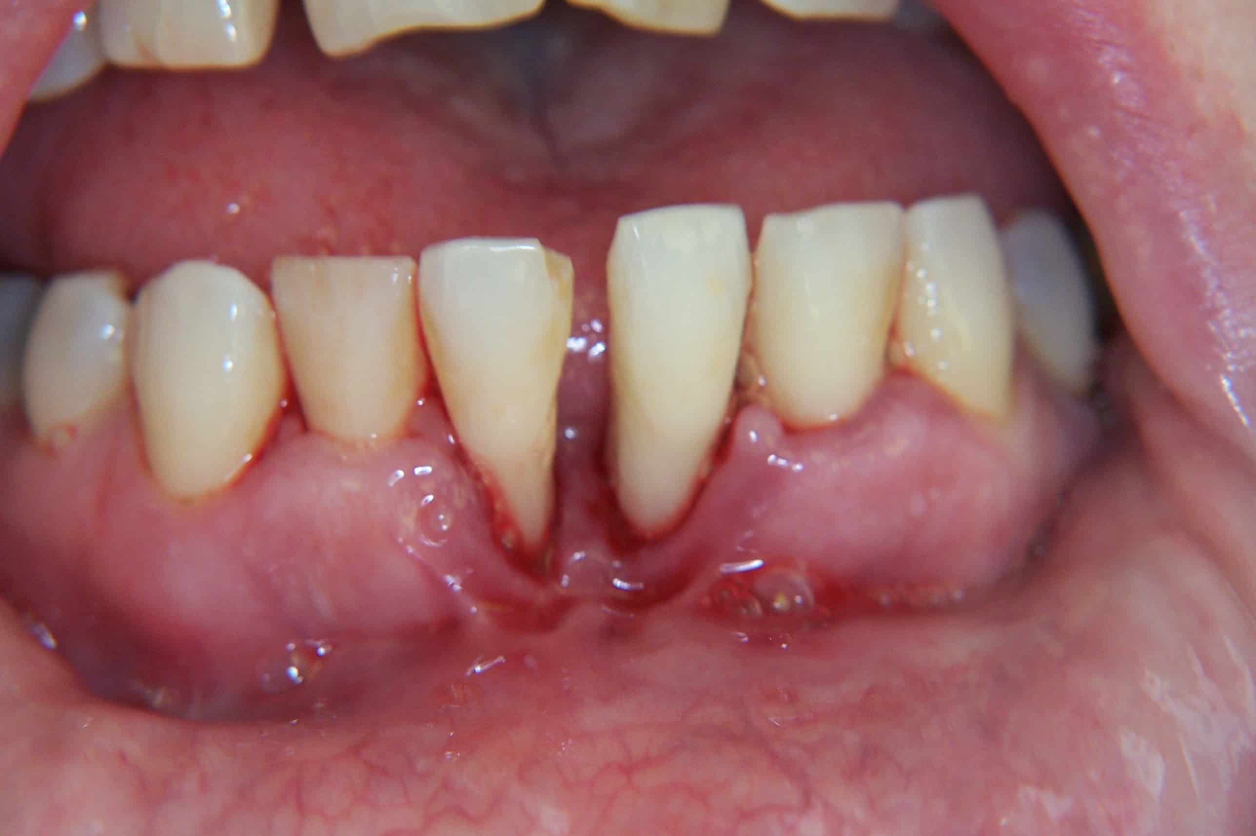 Can you get dental implants with periodontal disease? Yes, with treatment!